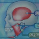 頭痛と歯科その3