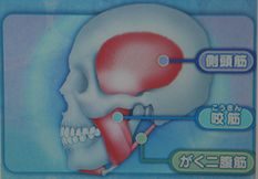頭痛と歯科その3