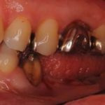 歯を失ってしまった場合の治療方法その３