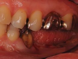 歯を失ってしまった場合の治療方法その３