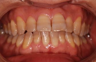 ホワイトニングで白い歯に