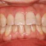 ホワイトニングで白い歯に！その７