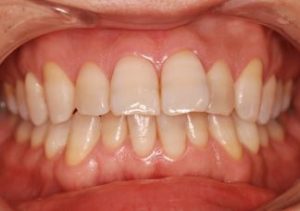 ホワイトニングで白い歯に！その７