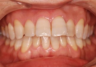 ホワイトニングで白い歯に