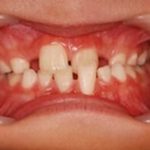 口腔内写真は何のため？その1