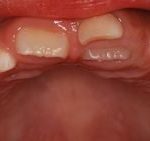 先生、おとなの歯が乳歯の後ろから生えてきました