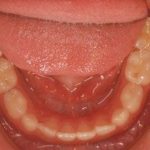 おとなの歯が乳歯の後ろから生えてきましたその５