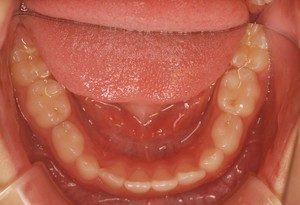 おとなの歯が乳歯の後ろから生えてきましたその５