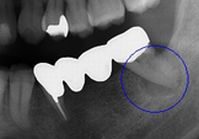 根の治療から１年７か月
