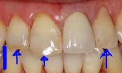 セラミックスによる審美治療