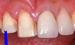 セラミックスによる審美治療その１