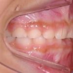 おとなの歯が乳歯の後ろから生えてきましたその8　